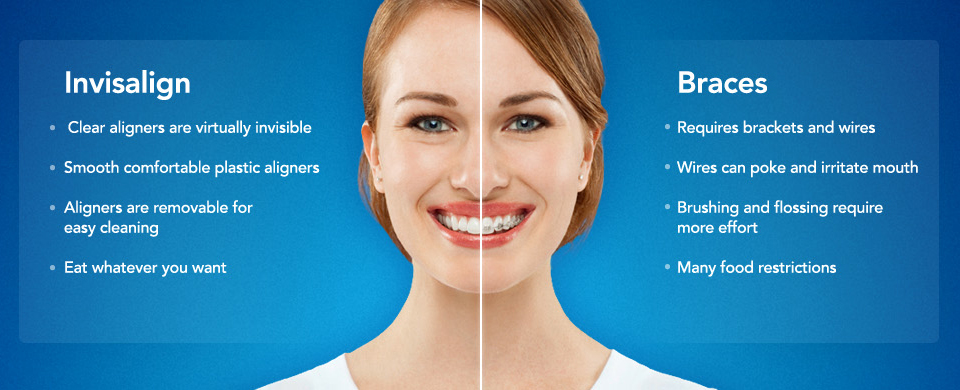 invisalign burnaby bc