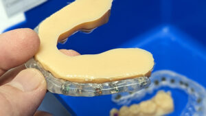 Tray fully trimmed 2 - First Impression Orthodontics IDB, Fast comfortable Braces