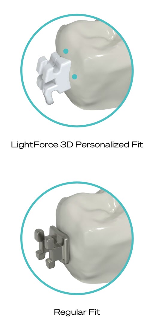 Spark Clear Aligners