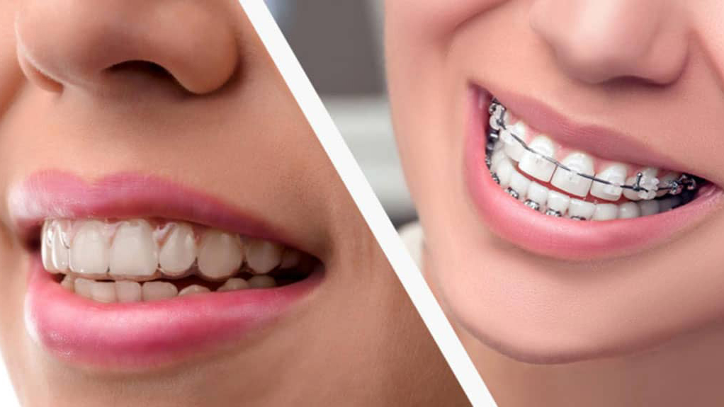 Common Treatment - First Impression Orthodontics