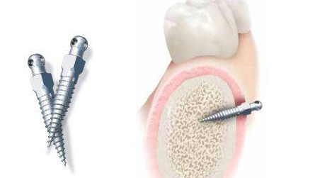 TADS - First Impression Orthodontics